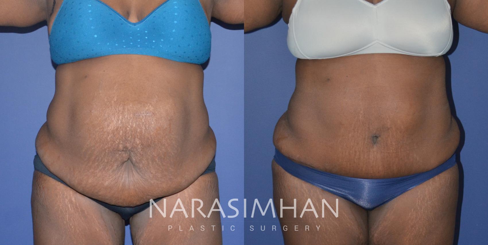 Before & After Tummy Tuck (Abdominoplasty) Case 257 View #1 View in Tampa, Florida
