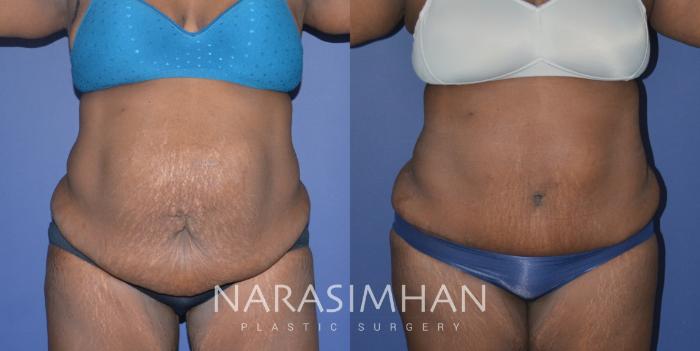 Before & After Liposuction Case 257 View #1 View in Tampa, Florida