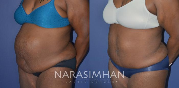 Before & After Liposuction Case 257 View #2 View in Tampa, Florida