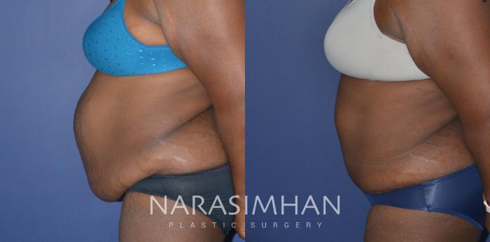 Before & After Liposuction Case 257 View #3 View in Tampa, Florida