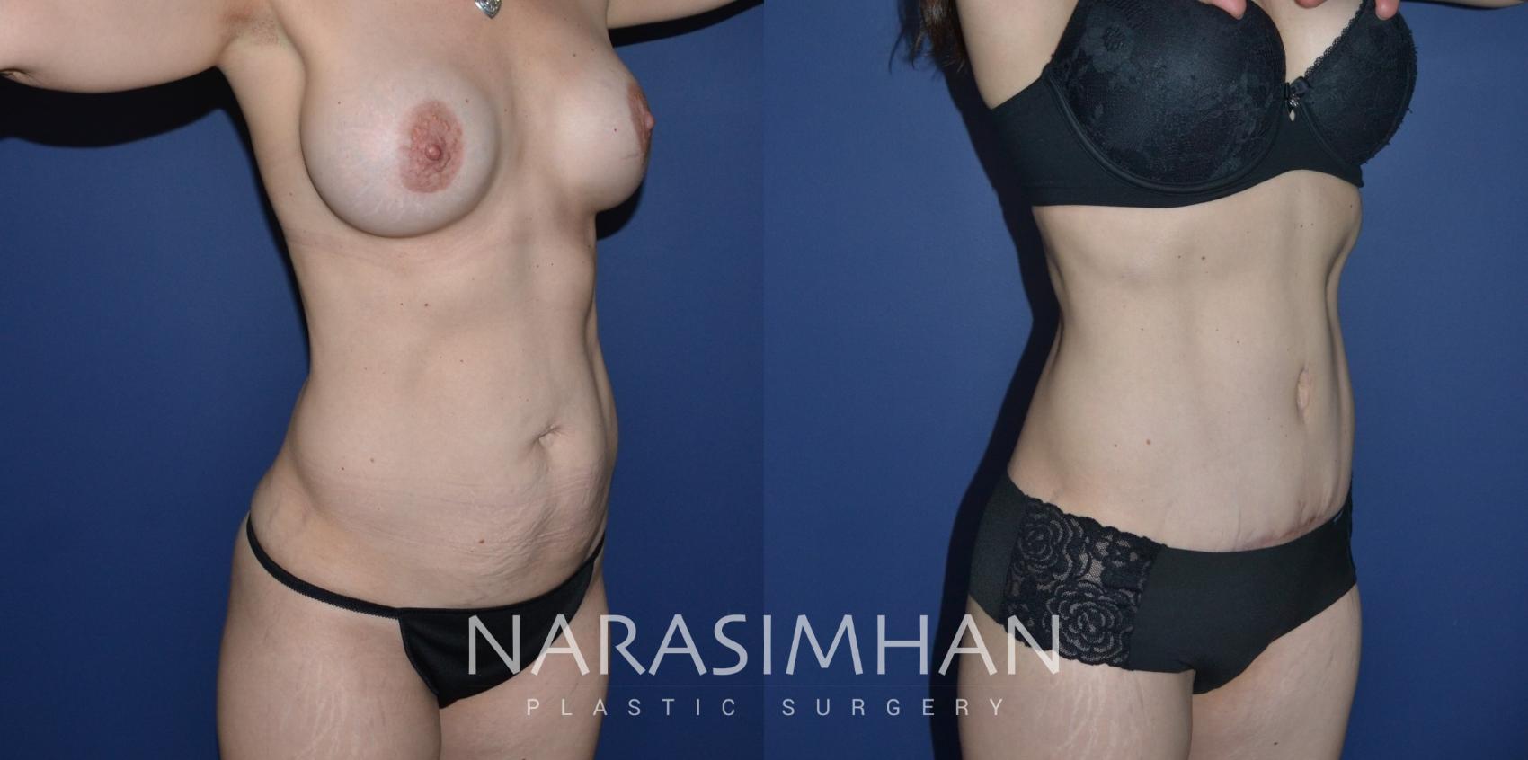 Before & After Tummy Tuck (Abdominoplasty) Case 279 View #1 View in St Petersburg, Florida