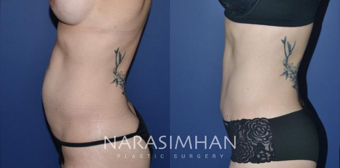 Before & After Tummy Tuck (Abdominoplasty) Case 279 View #2 View in Tampa, Florida