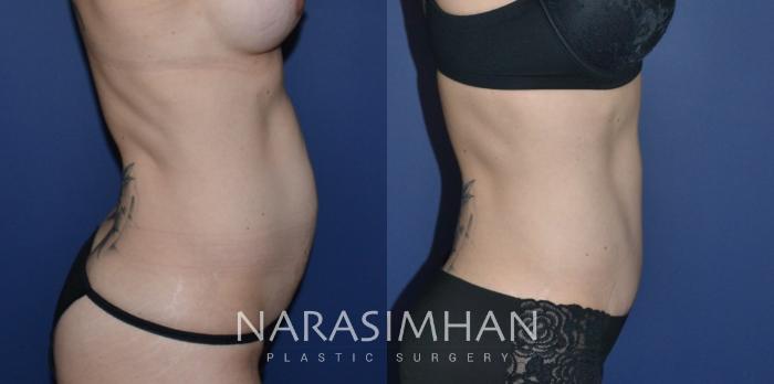Before & After Tummy Tuck (Abdominoplasty) Case 279 View #3 View in Tampa, Florida