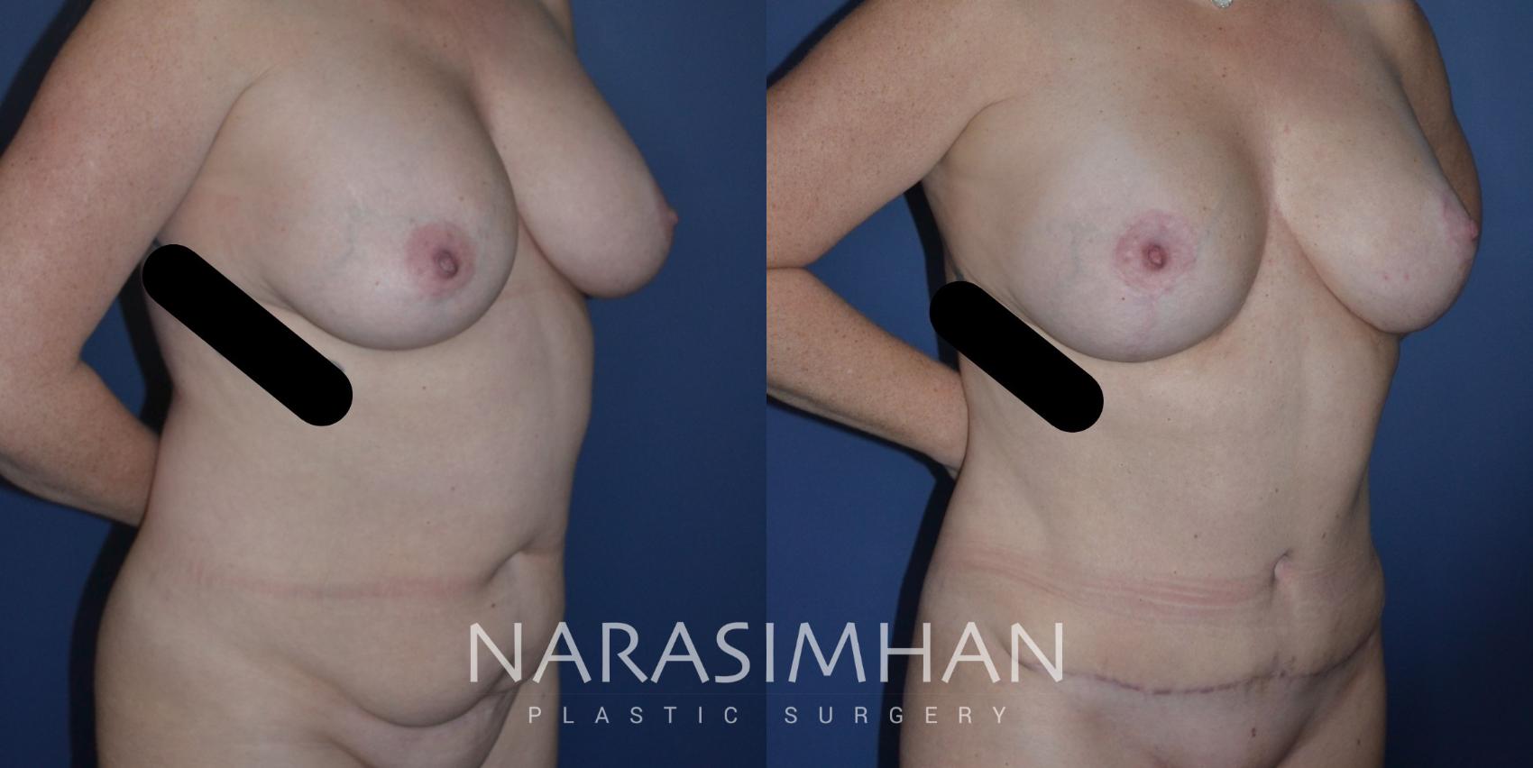 Before & After Breast Augmentation with Lift (Mastopexy) Case 297 Right Oblique View in St Petersburg, Florida