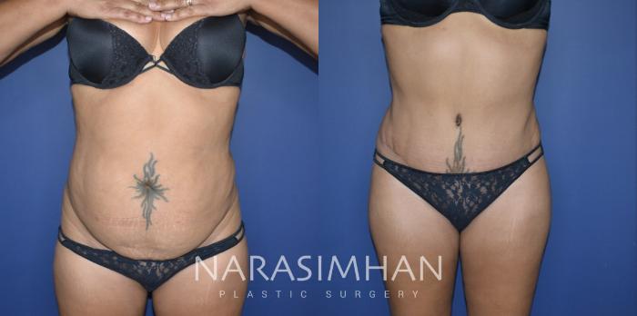 Before & After Liposuction Case 329 Front View in Tampa, Florida