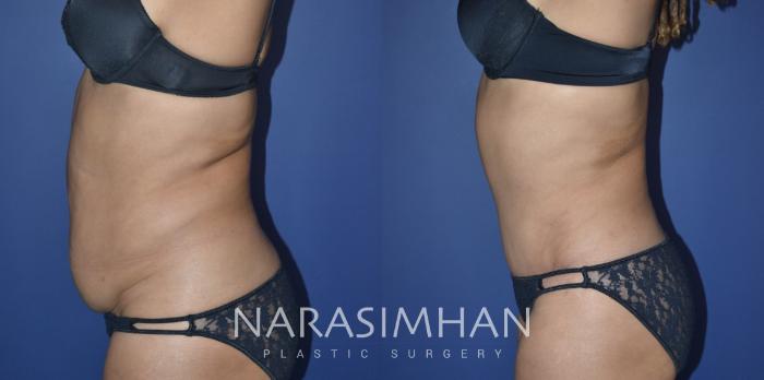 Before & After Tummy Tuck (Abdominoplasty) Case 329 Left Oblique View in Tampa, Florida