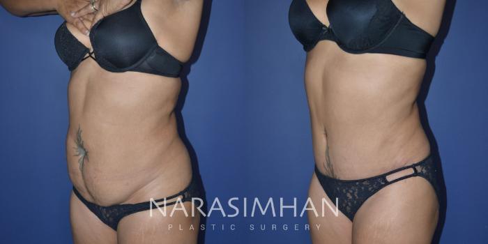 Before & After Tummy Tuck (Abdominoplasty) Case 329 Left Side View in Tampa, Florida