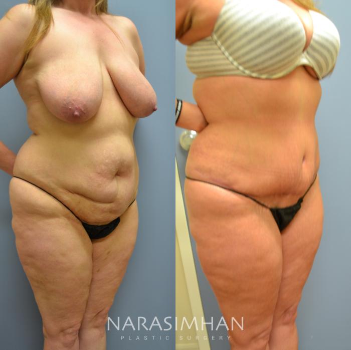 Before & After Tummy Tuck (Abdominoplasty) Case 36 View #2 View in Tampa, Florida