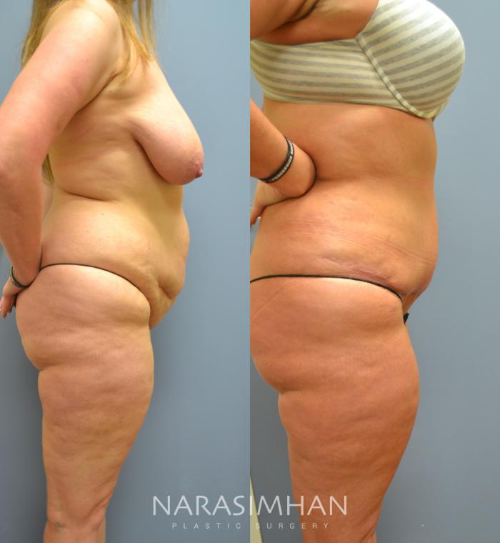 Before & After Tummy Tuck (Abdominoplasty) Case 36 View #3 View in Tampa, Florida