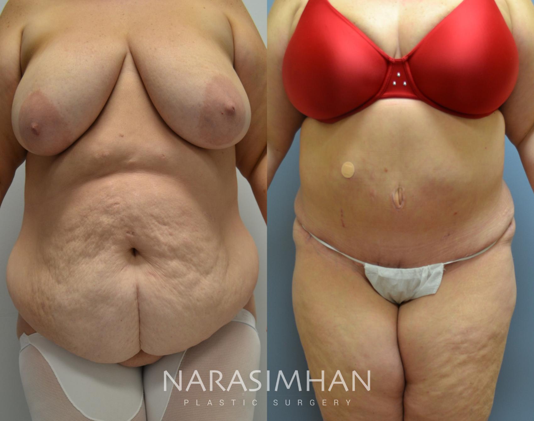 Before & After Tummy Tuck (Abdominoplasty) Case 37 View #1 View in Tampa, Florida