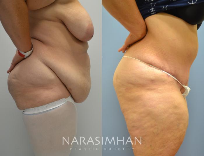 Before & After Tummy Tuck (Abdominoplasty) Case 37 View #2 View in Tampa, Florida