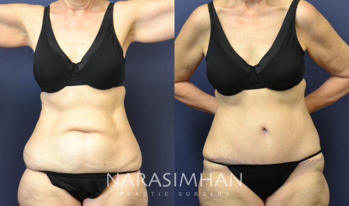 Before & After Tummy Tuck (Abdominoplasty) Case 72 View #1 View in Tampa, Florida