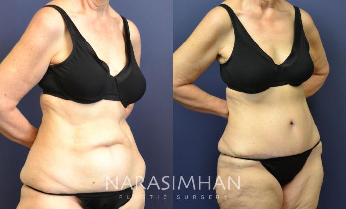 Before & After Tummy Tuck (Abdominoplasty) Case 72 View #2 View in Tampa, Florida