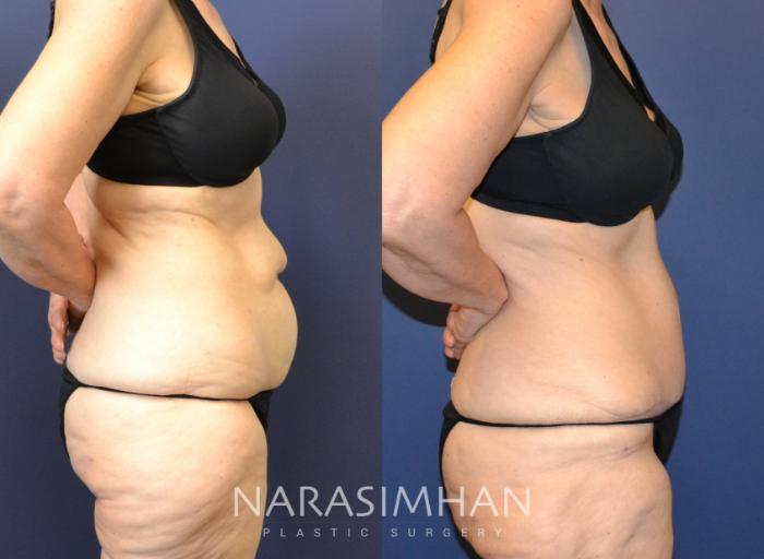 Before & After Tummy Tuck (Abdominoplasty) Case 72 View #3 View in Tampa, Florida