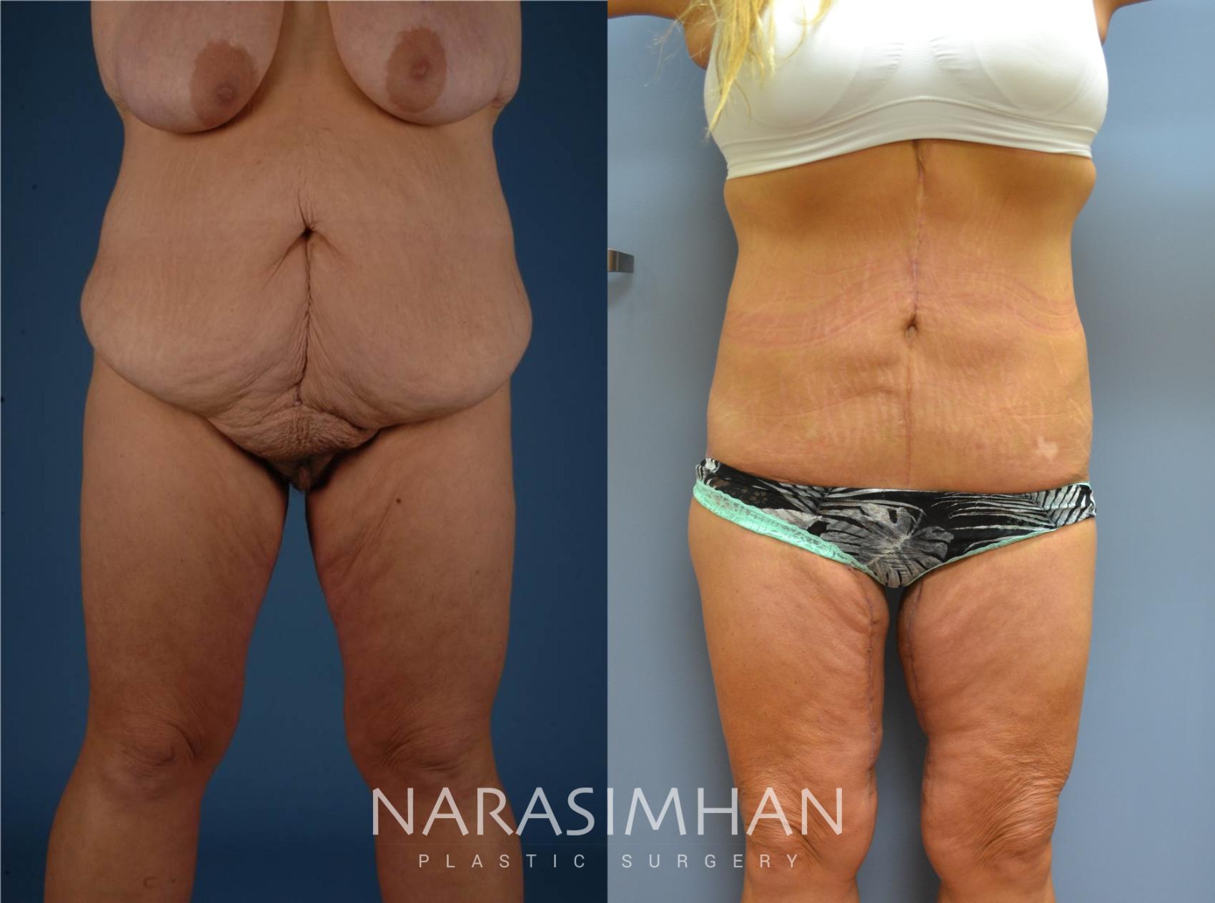 Before & After Tummy Tuck (Abdominoplasty) Case 75 View #1 View in St Petersburg, Florida