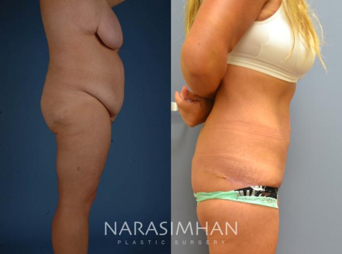 Before & After Thighplasty Case 75 View #3 View in Tampa, Florida