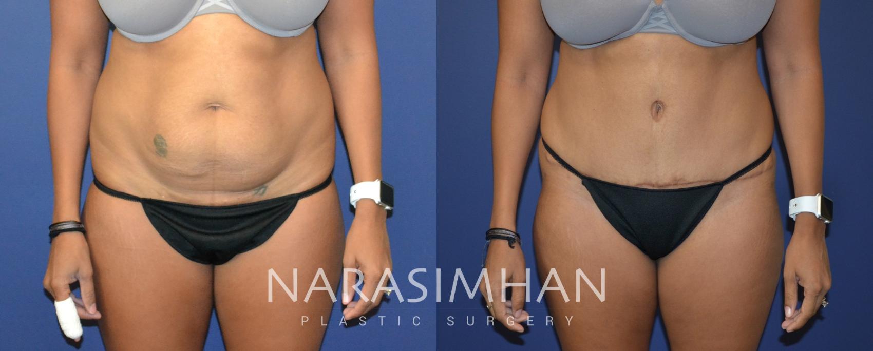 Before & After Tummy Tuck (Abdominoplasty) Case 82 View #1 View in Tampa, Florida
