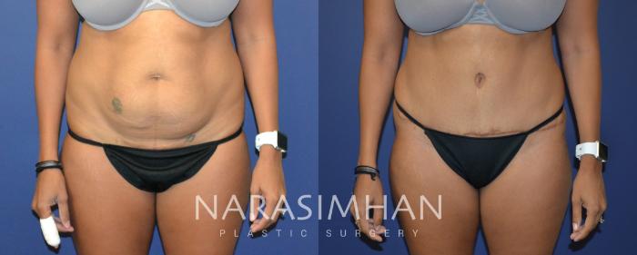 Before & After Tummy Tuck (Abdominoplasty) Case 82 View #1 View in Tampa, Florida