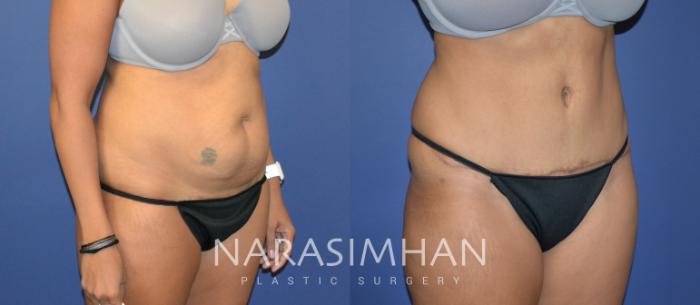 Before & After Tummy Tuck (Abdominoplasty) Case 82 View #2 View in Tampa, Florida