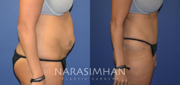 Before & After Tummy Tuck (Abdominoplasty) Case 82 View #3 View in Tampa, Florida