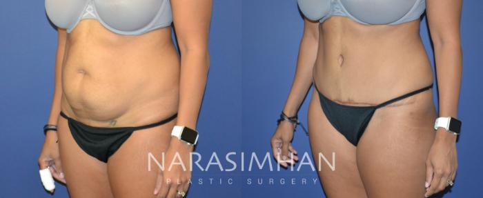 Before & After Tummy Tuck (Abdominoplasty) Case 82 View #4 View in Tampa, Florida