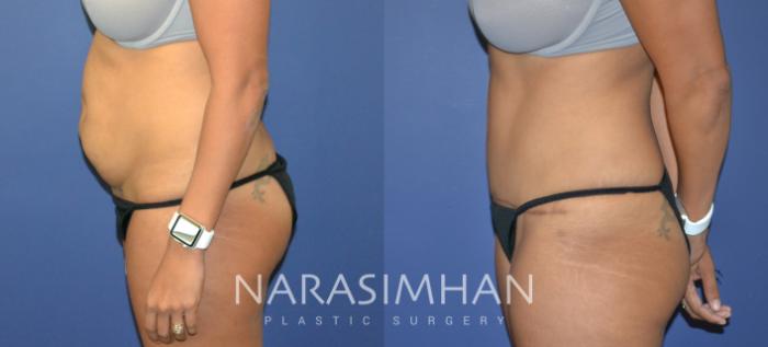 Before & After Tummy Tuck (Abdominoplasty) Case 82 View #5 View in Tampa, Florida